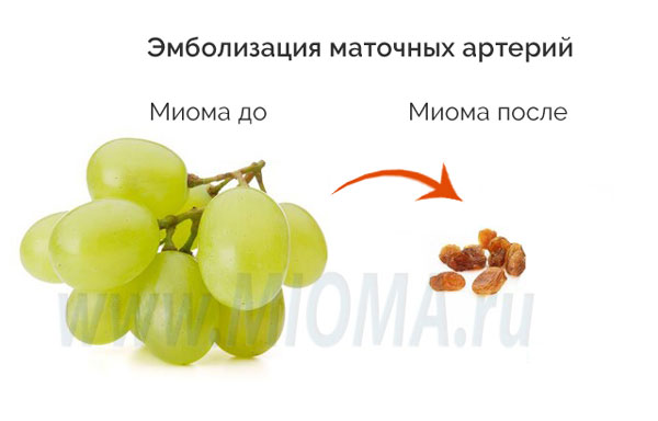 Миома после ЭМА